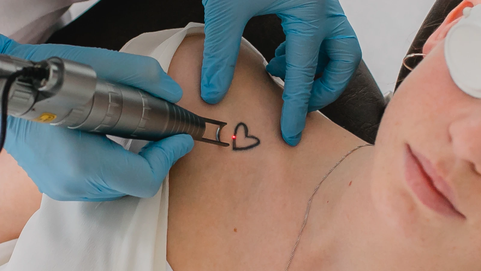 Tattooentfernung mit dem Laser in der HautarztPraxis Hannover