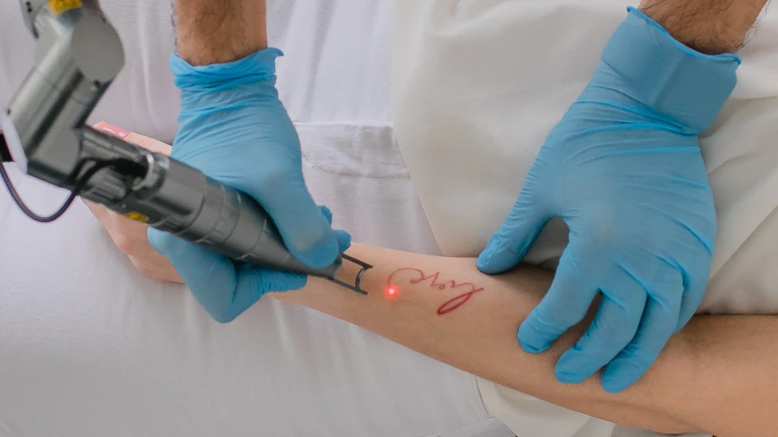 Laserbehandlung zur Tattooentfernung in Hannover