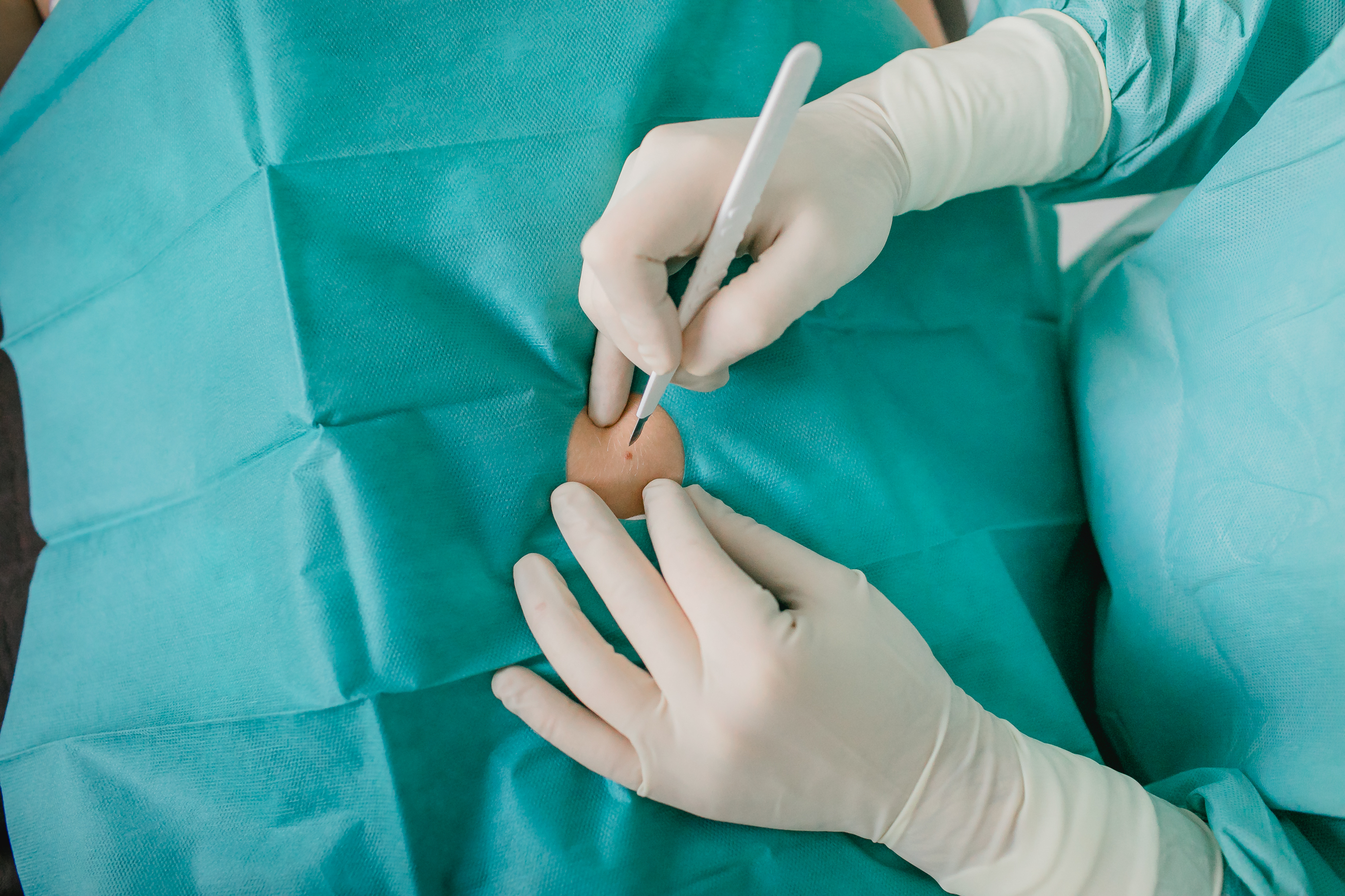 Dermatochirurgische Eingriffe ambulant in Hannover